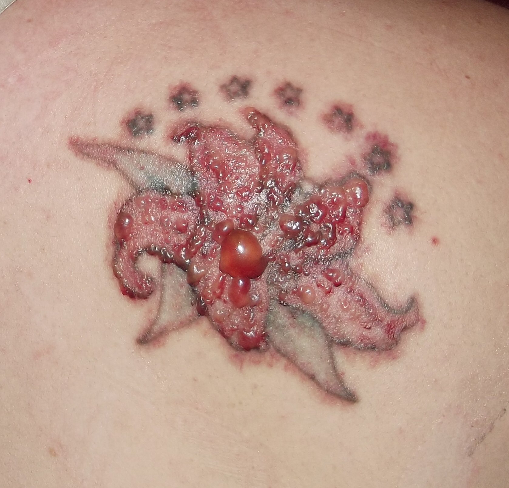 My Experience With R20 Laser Tattoo Removal